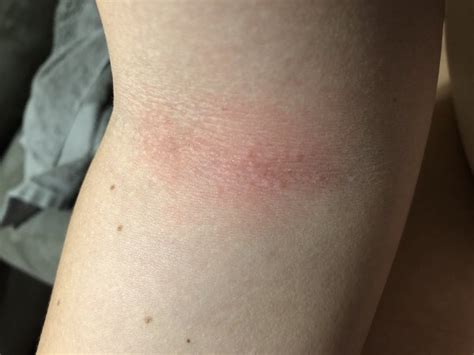 What Is This Rash Its On My Arm Dont Worry Babycenter