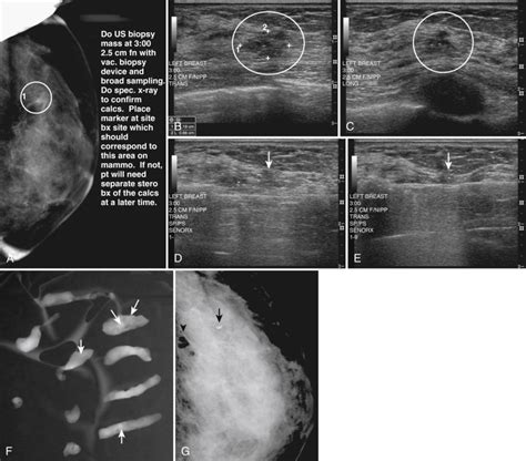 Mammographic And Ultrasound Guided Breast Biopsy Procedures Clinical Tree