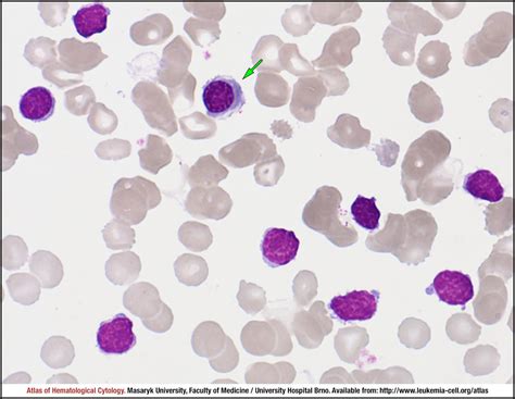 Chronic Lymphocytic Leukaemia Classic Morphology Cell Atlas Of