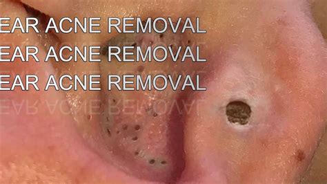 Huge Ear Acne Removal 2021 Youtube