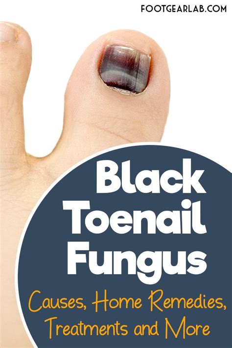 Black Toenail Fungus Causes Home Remedies Treatments And More