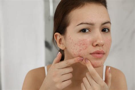 An Easy Skincare Routine For Acne Prone Skin Poko Cbd