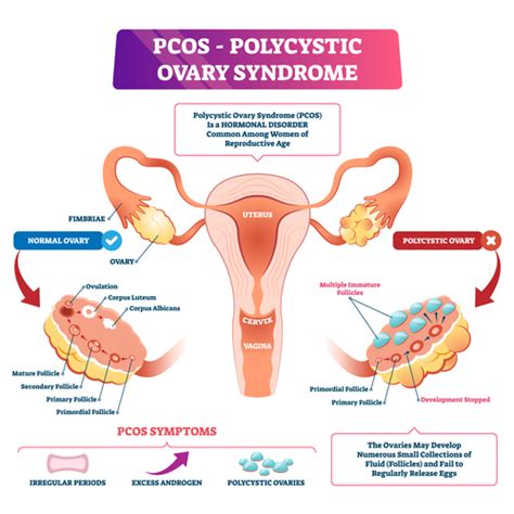 Pcos Signs Symptoms And Treatments Cool Springs Obgyn