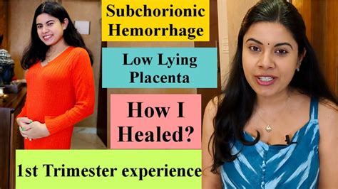 Pregnancy First Trimester Experience Subchorionic Hemorrhage Low