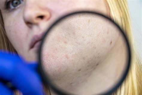 Acne Scars And Keloids In The Chest Of Man Stock Photo Image Of