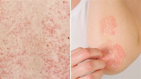 Dermatitis At Pica C Mo Identificarla Y No Confundirla Con Un Problema