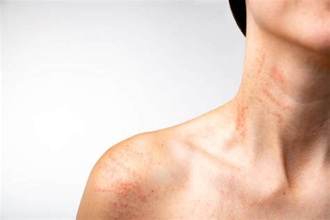 Understanding Contagious Skin Rashes Discovery Body