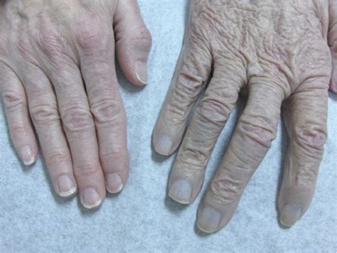 Blue Gray Discoloration Of The Skin Aafp