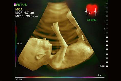 What Is Fetal Echocardiogram And Why Is It Done