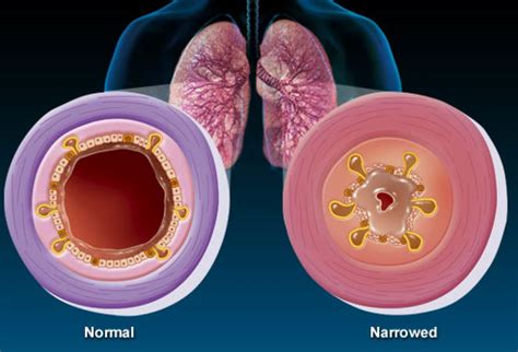 How To Tell If Bronchitis Is Turning Into Pneumonia Evidence Based
