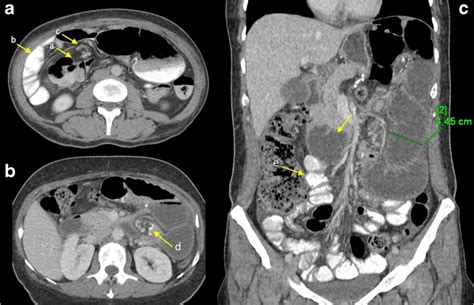A Axial Abdominal Ct Image After Oral Contrast Medium Administration
