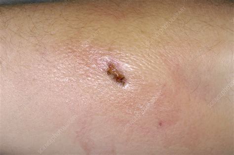 Infected Wound On The Arm Stock Image C0042402 Science Photo Library