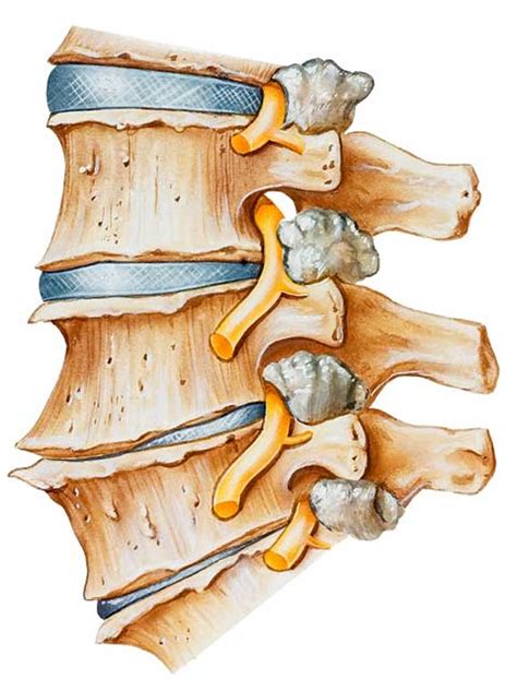 Spurs In The Spine What Are Lumbar Osteophytes Bone Spurs When