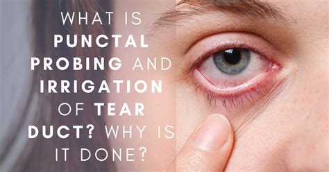 What Is Punctal Probing And Irrigation Of Tear Duct