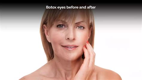 2024 Botox Eyes Before And After Pics Easy Peasy Skincare