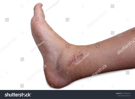 723 Ankle Scar Images Stock Photos And Vectors Shutterstock