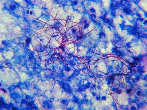 Nocardia Microbiology Medbullets Step 1