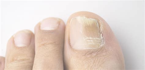 Ottawa Foot Clinic Long Lasting Solutions For Your Foot And Toenails