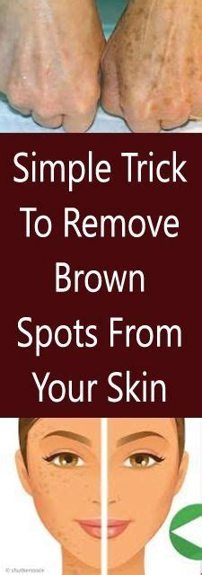 Simple Trick To Remove Brown Spots From Your Skin Brown Spots On Skin