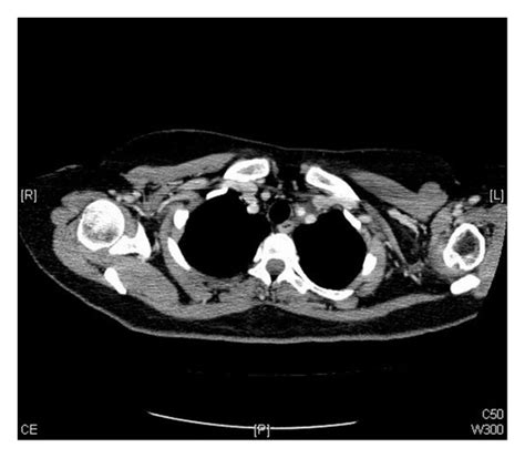 Postchemotherapy Ct Scan Axial Images Showing A Decrease In The Size Of