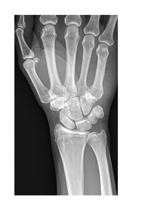 Hand X Ray Emergucate