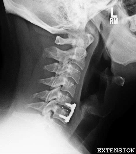 What Is A Three Level Cervical Fusion Waldo Field
