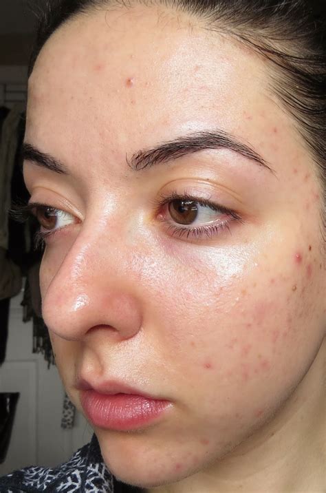 My Skins Journey Week 12 Banish Acne Scars