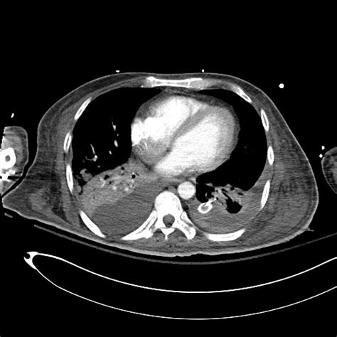 Pleural effusion is the accumulation of pathological fluid in the pleural cavity with inflammatory processes in adjacent organs or pleural sheets or when the ratio between colloid osmotic pressure of the blood plasma and hydrostatic pressure in the capillaries is disturbed. Differential Diagnosis of Pleural Effusion