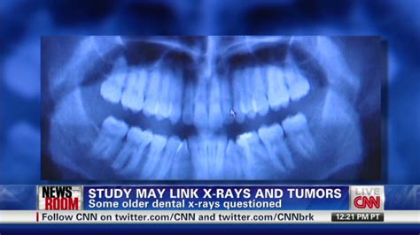 Dental X Rays And Brain Tumors Cnn Video