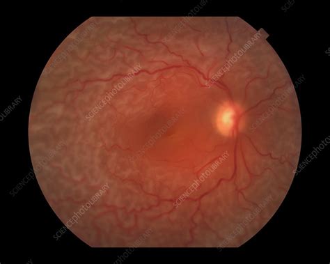 Retinal Detachment Stock Image C0271158 Science Photo Library