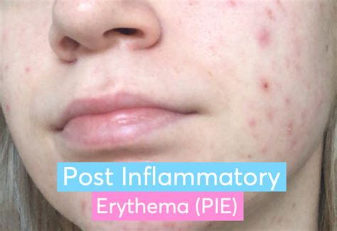 Everything You Need To Know About Post Inflammatory Erythema Mdacne