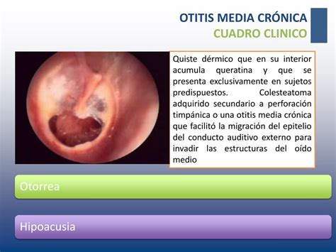 Ppt Otitis Media Cronica Powerpoint Presentation Free Download Id