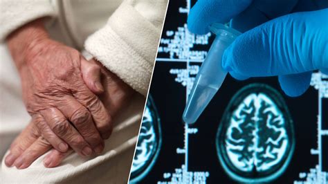 First New Alzheimers Drug In 20 Years Approved In The Us Heart