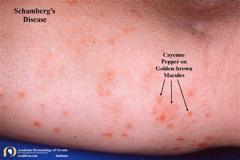 Schambergs Disease A Pigmentary Purpuric Eruption Academic