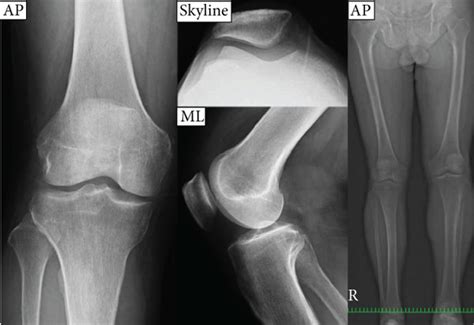 Valgus Knee And Patellar Instability Appeared On A Plane X Ray With A