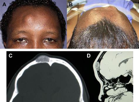 Reconstruction Of The Scalp Calvarium And Frontal Sinus Oral And