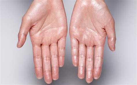 10 Solutions You Need To Treat Sweaty Hands Skinkraft