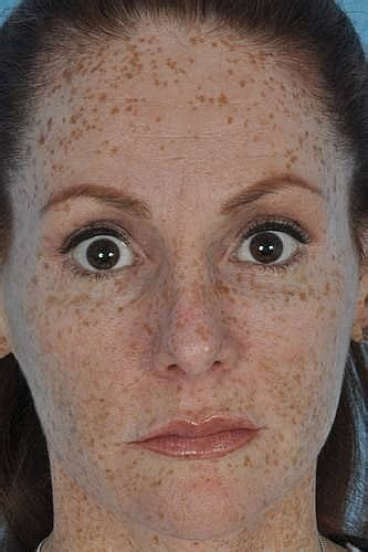 Brown Spots On Face Causes Treatment Prevention Pictures Healthmd