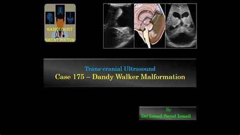 Ultrasound Case 175 Dandy Walker Malformation Youtube