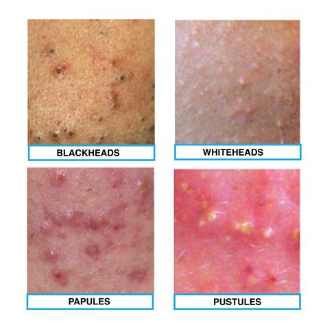 The Four Types Of Acne Blackheads Whiteheads Papule And Pustules
