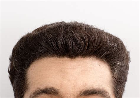 Hair transplant cost los angeles | dr. Hairline Density | Hair restoration surgery, Hair ...