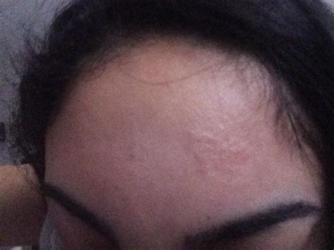 What Is This Patch Of Bumps On My Forehead Hypertrophic Raised