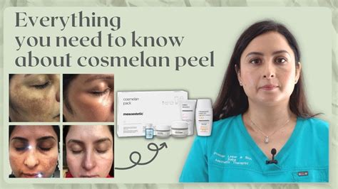 Cosmelan Peel Senior Practitioners Guide To Hyperpigmentation