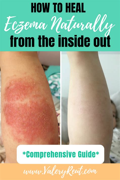 How To Heal Eczema Naturally From The Inside Out Natural Eczema