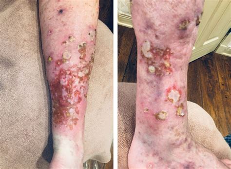 Severe Lichenoid Drug Eruption From Pembrolizumab Skin Cancer And