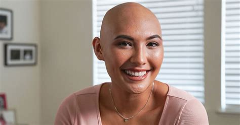 20 Year Old Woman With Alopecia Totalis Hopes To Inspire People With