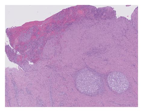 Histopathology Of The Supraclavicular Ganglion Exeresis Case 1