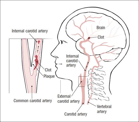 The arteria profunda linguæ (ranine artery; Carotid artery disease - Harvard Health