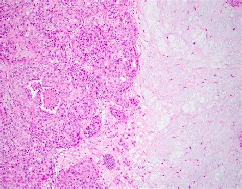 Pathology Outlines Carcinoma Ex Pleomorphic Adenoma