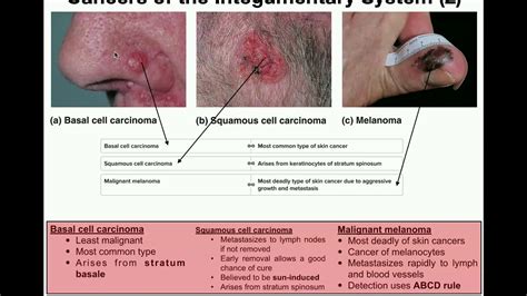 Anatomy The Three Types Of Skin Cancers Youtube